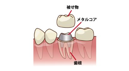 金属の土台（メタルコア）