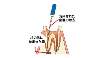 感染根管治療