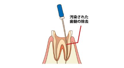 抜髄根管治療