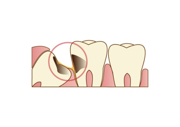 虫歯になっている