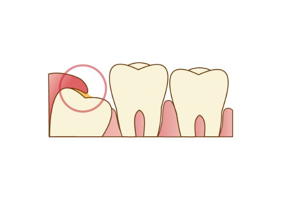 智歯周囲炎を繰り返す